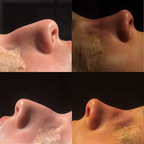 antesedepois8